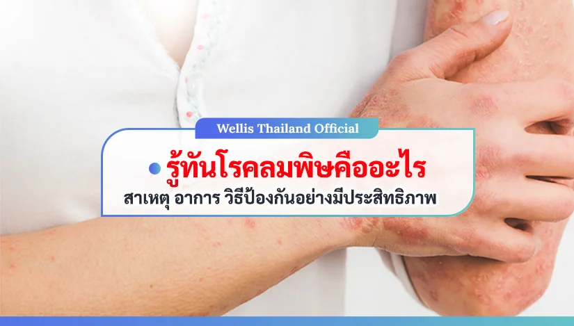 รู้ทันโรคลมพิษคืออะไร สาเหตุ อาการ วิธีป้องกันอย่างมีประสิทธิภาพ