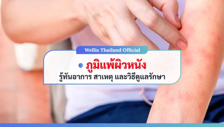 ภูมิแพ้ผิวหนัง รู้ทันอาการ สาเหตุ วิธีดูแล